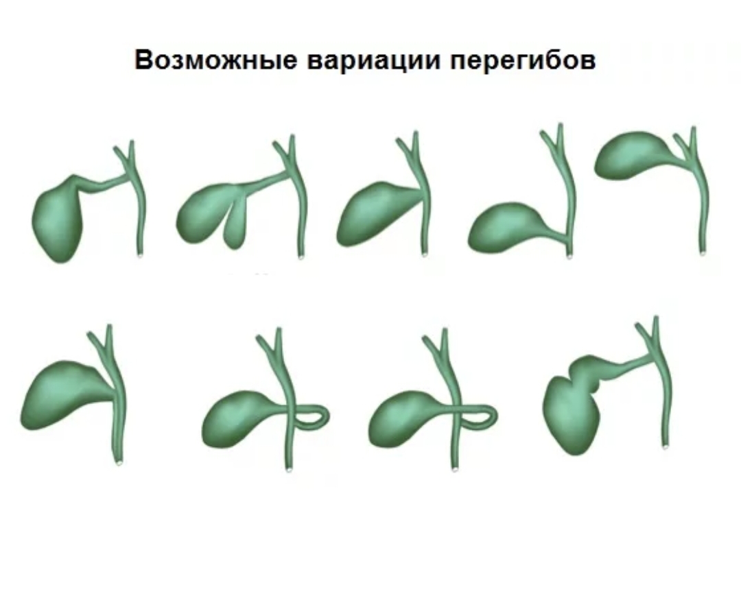 Желчный пузырь у новорожденного. Форма желчного пузыря с перегибом. Желчный пузырь грушевидной формы с перегибом. Загиб дна желчного пузыря. Перегиб желчного пузыря в средней трети.